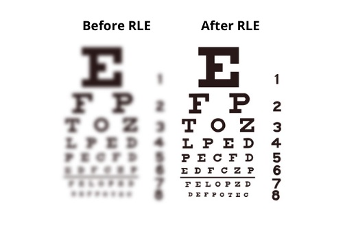 Before and after refractive lens exchange