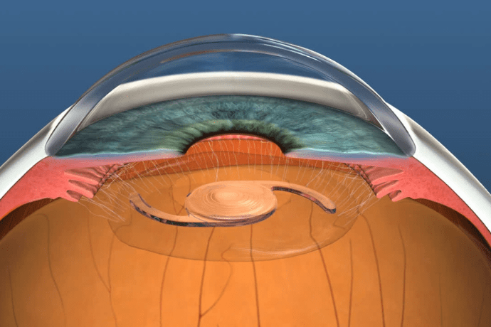 refractive lens exchange